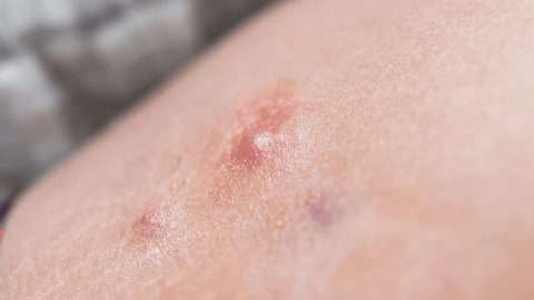 hidradenitis suppurativa, chronic skin condition, HS, inflammatory skin disease, derm institute of west michigan, caledonia mi,