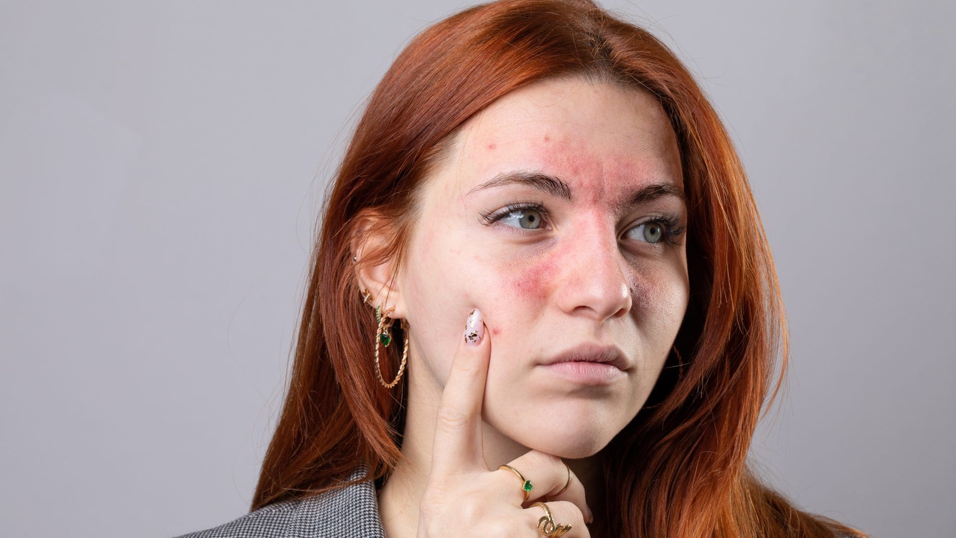 derm institute of west michigan, caledonia mi, derm institute of west mi, rosacea, rosacea awareness month, calming the redness