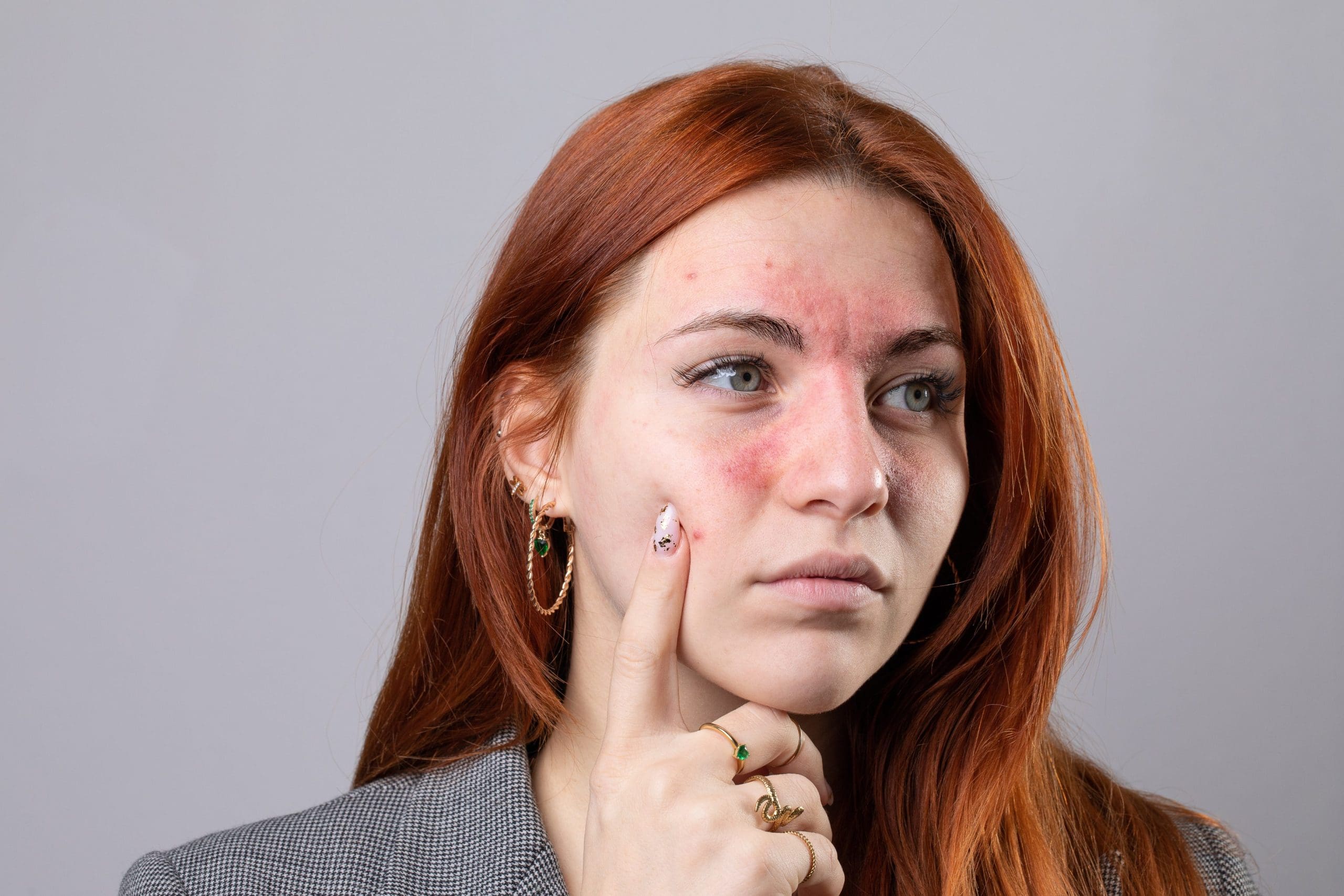 derm institute of west michigan, caledonia mi, derm institute of west mi, rosacea, rosacea awareness month, calming the redness